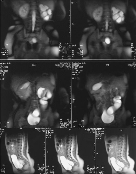 Магнитно-резонансная томография - на серии снимков визуализируется тяжелый уретерогидронефроз слева с резко истонченной паренхимой почки