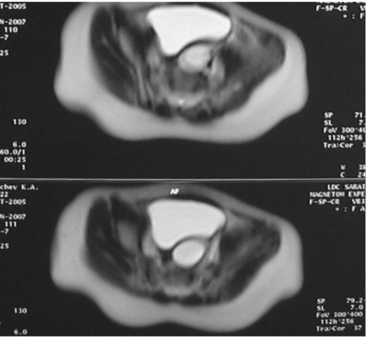 Магнитно-резонансная томография (поперечный срез) - визуализируется заполненный мочой мочевой пузырь и над ним резко расширенный дистальный отдел мочеточника (тот же больной)