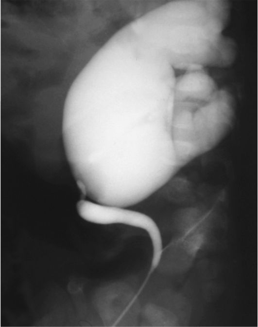 Восходящая уретеропиелография слева (тот же больной) - врожденный огромный, нефункционирующий гидронефроз; отчетливо визуализируется сужение мочеточника в прилоханочном отделе