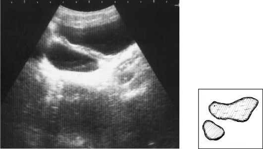 Ультрасонограмма мочевого пузыря над мочевым пузырем слева виден резко расширенный мочеточник - левосторонний мегауретер
